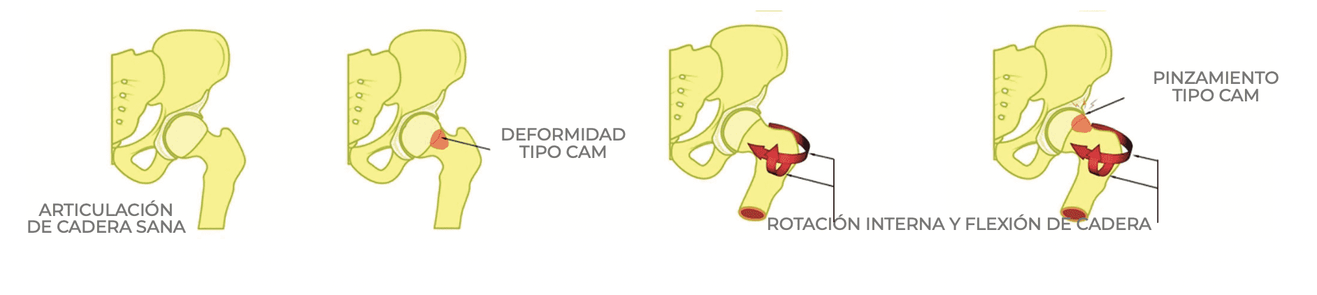 Artrosis de cadera tipo cam femoral
