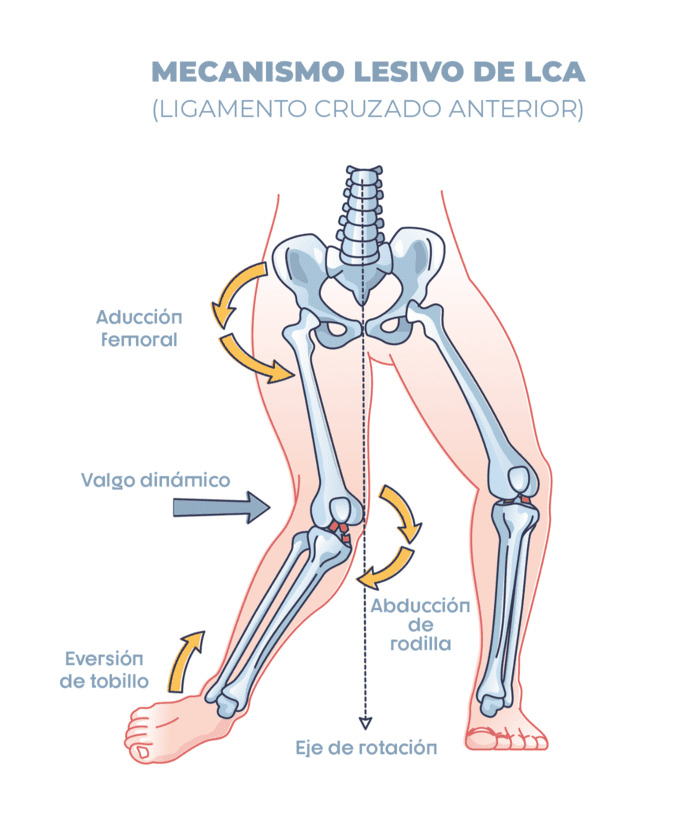 lesión del ligamento cruzado anterior de la rodilla