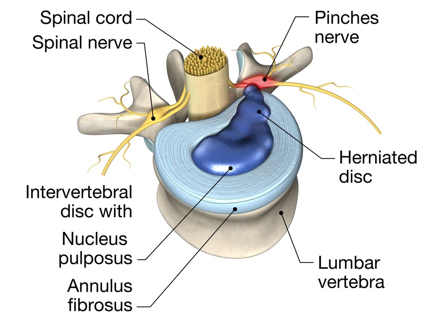 Hernia Discal